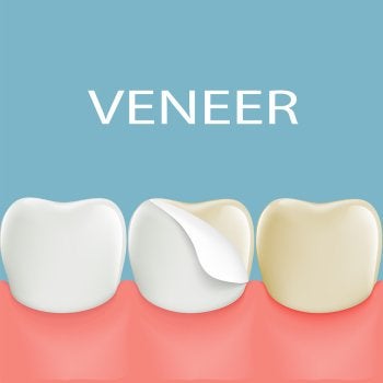 dental - veneers